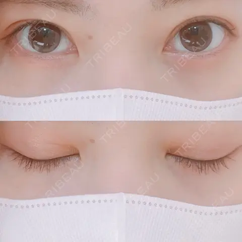 二重埋没 AILE Clinic AFTER