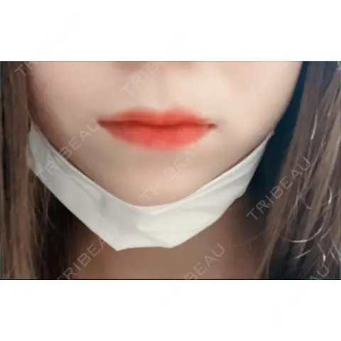 人中短縮 / ボトックス（口角） S-Laboクリニック 渋谷院 AFTER