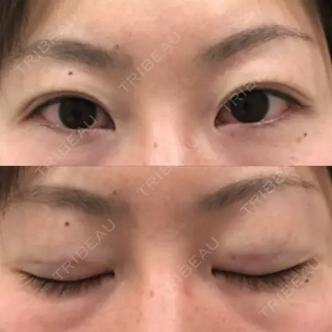 二重埋没 アリエル美容クリニック 郡山院 DAY 0