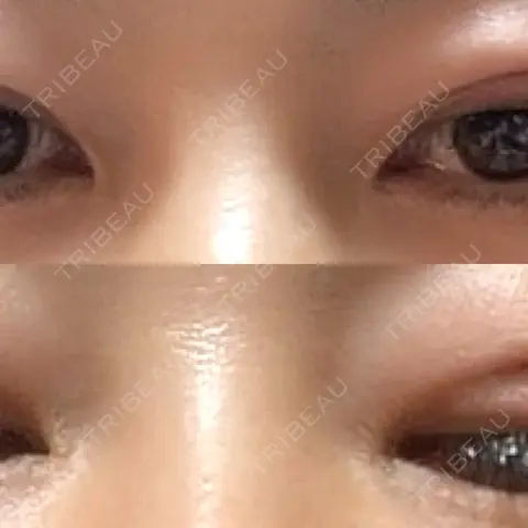 二重埋没 アリエル美容クリニック 郡山院 DAY 0