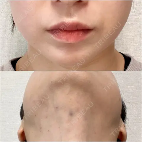 ボトックス（エラ・小顔） / 脂肪溶解注射（顔） / 脂肪溶解注射 渋谷美容外科クリニック 渋谷院 DAY 0