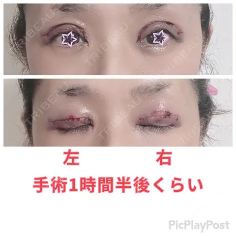 二重切開 / 眼瞼下垂（切開） / 上まぶたたるみ取り 心斎橋形成外科スキンケアクリニック DAY 0