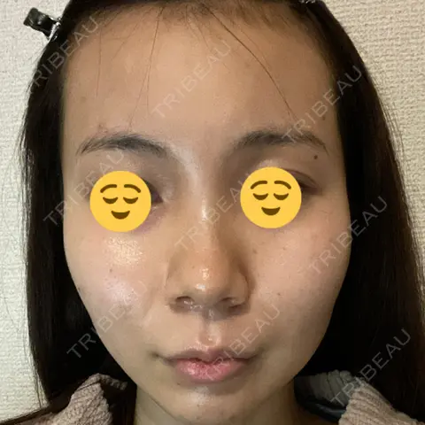 医療脱毛（顔） トイトイトイクリニック 池袋院 AFTER