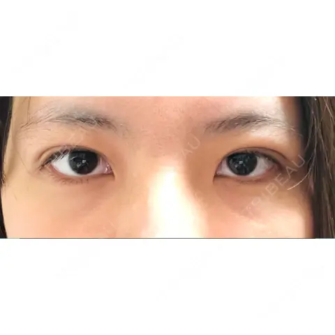 二重埋没 アリエル美容クリニック 郡山院 DAY 0