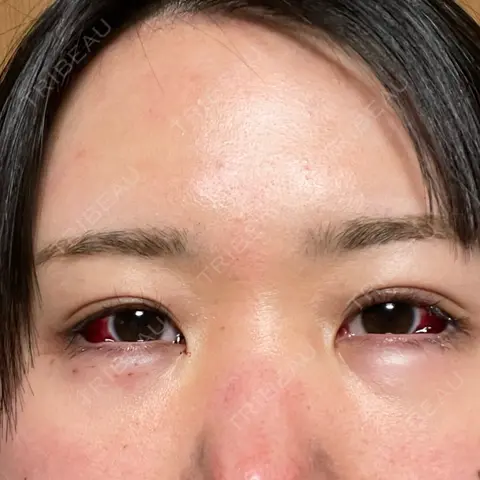 下まぶたたるみ取り TCB東京中央美容外科 高崎院 DAY 0
