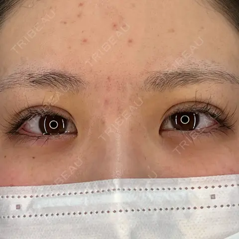 二重埋没 / ヒアルロン酸注入（涙袋） HAAB×DREAM BEAUTY CLINIC 大阪梅田院 DAY 0