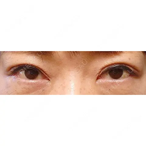 二重埋没 アリエル美容クリニック 郡山院 AFTER