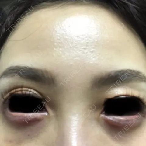 ヒアルロン酸注入（涙袋） AI Beauty Clinic （エーアイ美容クリニック） DAY 0