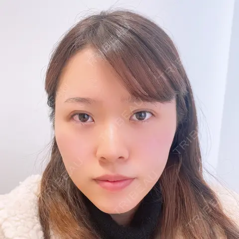 二重埋没 NARU Beauty Clinic 【ナルクリ】 DAY 0