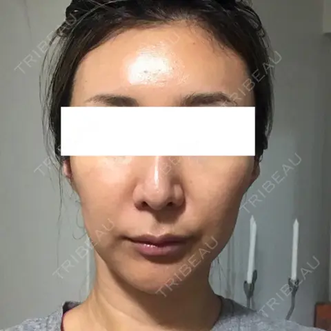 輪郭修正 / その他（輪郭） ニューセンス皮膚科クリニック DAY 1