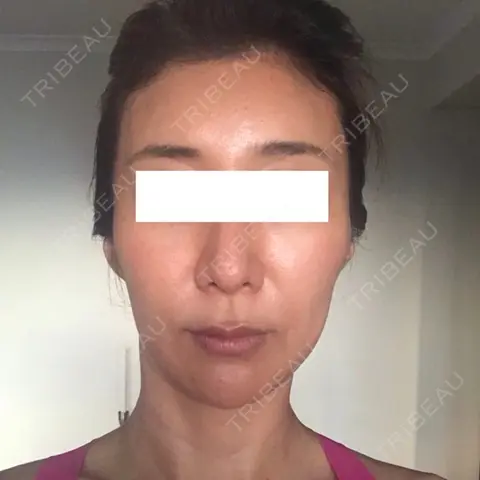 輪郭修正 / その他（輪郭） ニューセンス皮膚科クリニック AFTER