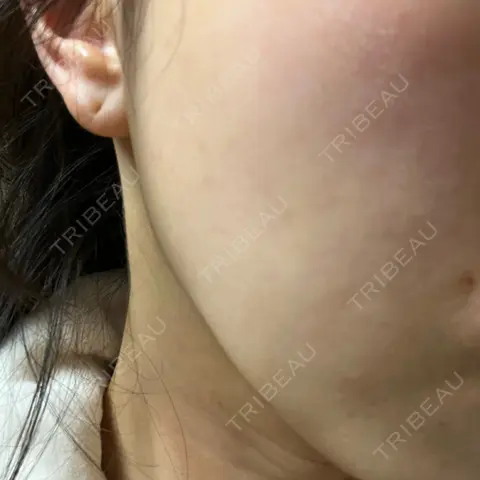 ピーリング（ニキビ・毛穴） まゆりなclinic 名古屋栄 AFTER