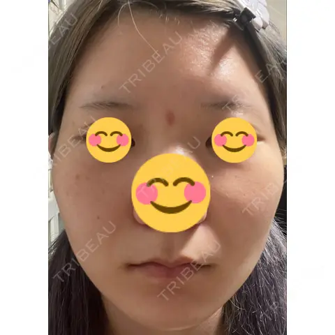 ボトックス（エラ・小顔） AI Beauty Clinic （エーアイ美容クリニック） DAY 5