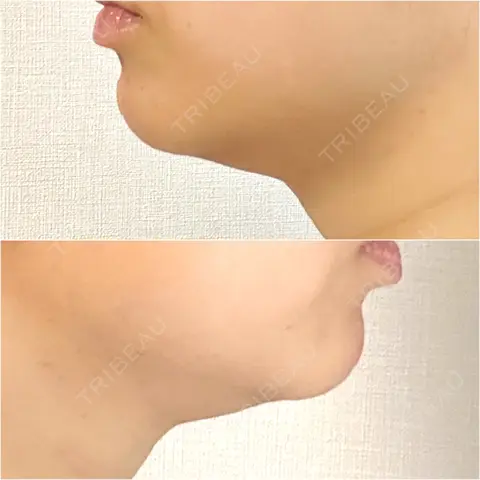 ボトックス（エラ・小顔） / 脂肪溶解注射（顔） / 脂肪溶解注射 渋谷美容外科クリニック 渋谷院 AFTER