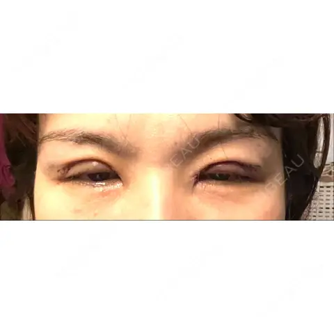 二重切開 / 上まぶたたるみ取り 心斎橋形成外科スキンケアクリニック DAY 0