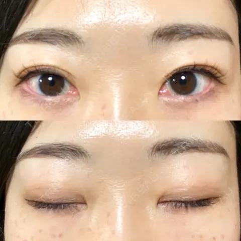 二重切開 / 上まぶたたるみ取り / PRP皮膚再生療法 BRIGHTS beauty clinic AFTER
