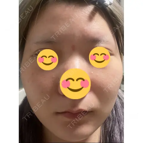 ボトックス（エラ・小顔） AI Beauty Clinic （エーアイ美容クリニック） AFTER