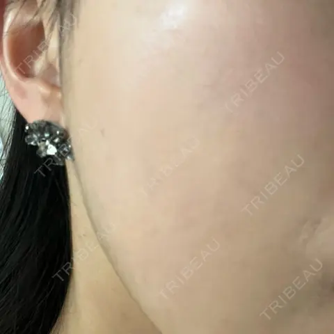 ピーリング（ニキビ・毛穴） まゆりなclinic 名古屋栄 AFTER