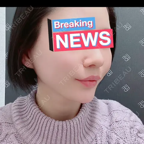 糸リフト EMMO FACE CLINIC 大宮院 DAY 0