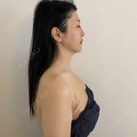 インディバ（顔） Medical Indiba Salon KMK【脂肪吸引後ダウンタイム専門サロン】 AFTER