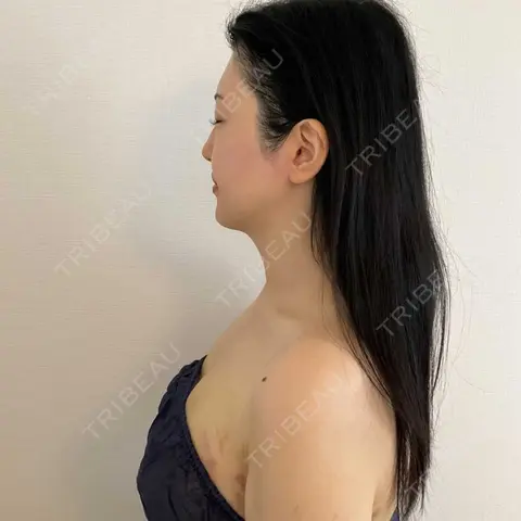 インディバ（顔） Medical Indiba Salon KMK【脂肪吸引後ダウンタイム専門サロン】 AFTER