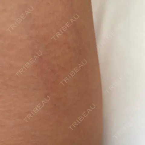 脂肪冷却（太もも） THE GINZA CLINIC AFTER