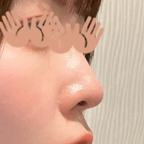 軟骨移植 フェアクリニック川口 AFTER
