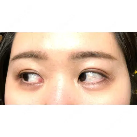 下まぶたたるみ取り TCB東京中央美容外科 高崎院 AFTER