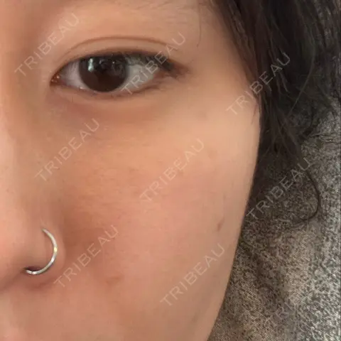 ヒアルロン酸注入（頬） Kalon Clinic AFTER
