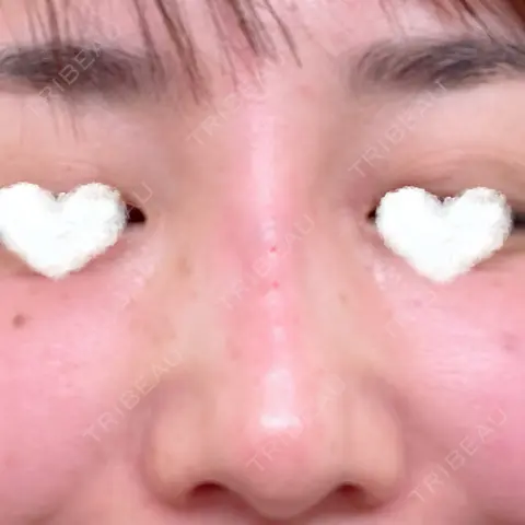 ヒアルロン酸注入（鼻） ももスキンケアクリニック DAY 0