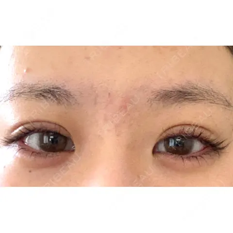 二重埋没 / ヒアルロン酸注入（涙袋） HAAB×DREAM BEAUTY CLINIC 大阪梅田院 AFTER