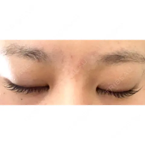 二重埋没 / ヒアルロン酸注入（涙袋） HAAB×DREAM BEAUTY CLINIC 大阪梅田院 AFTER