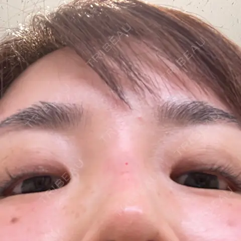 PRP皮膚再生療法 / その他（目元） ももスキンケアクリニック DAY 0