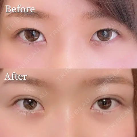 二重埋没 NARU Beauty Clinic 【ナルクリ】 AFTER