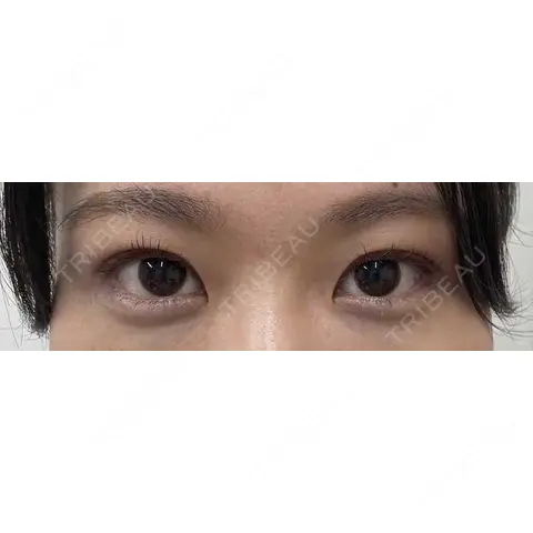 ヒアルロン酸注入（涙袋） 渋谷美容外科クリニック 新橋院 AFTER