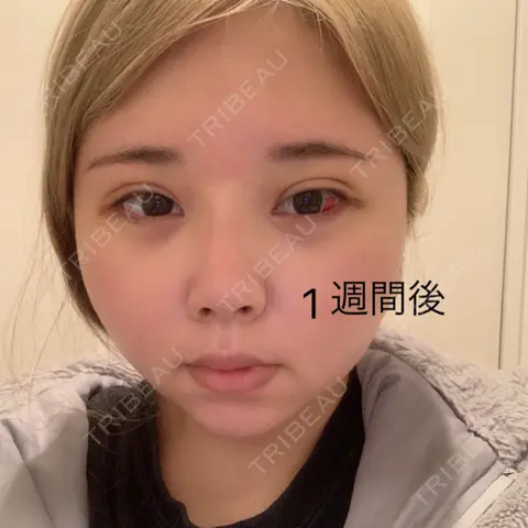 クマ治療 / 上まぶたの脂肪取り / 自然癒着法 / 小鼻縮小（非切開） / ヒアルロン酸注入（涙袋） / ヒアルロン酸注入（鼻） / ヒアルロン酸注入（唇） / ボトックス（人中） 東京秘密クリニック 渋谷院 AFTER