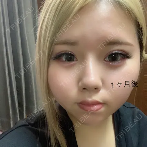 クマ治療 / 上まぶたの脂肪取り / 自然癒着法 / 小鼻縮小（非切開） / ヒアルロン酸注入（涙袋） / ヒアルロン酸注入（鼻） / ヒアルロン酸注入（唇） / ボトックス（人中） 東京秘密クリニック 渋谷院 AFTER