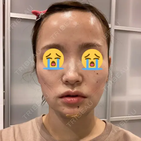 脂肪吸引（顔） / 輪郭修正 / ジョールファット除去 / 脂肪注入（輪郭） WOM CLINIC GINZA （ワム クリニック ギンザ） DAY 0