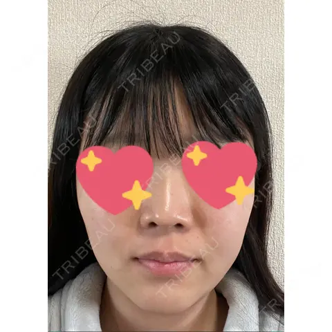 ピーリング（ニキビ・毛穴） ロナロナクリニック DAY 0
