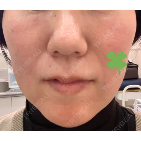 PRP皮膚再生療法 ノリス美容クリニック DAY 0