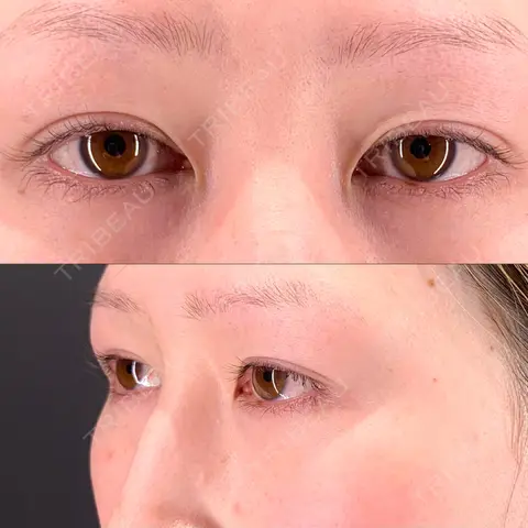 上まぶたの脂肪取り / 美容点滴・美容注射（美肌） / 美容点滴・美容注射（疲労回復） HAAB×DREAM BEAUTY CLINIC 大阪梅田院 DAY 0