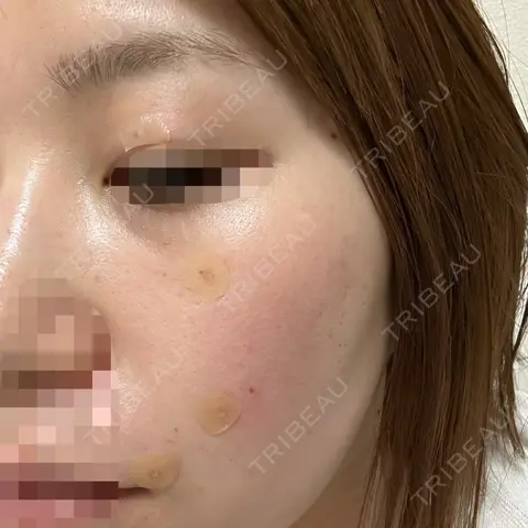 ほくろ・いぼ除去レーザー（肌） 心斎橋形成外科スキンケアクリニック DAY 0