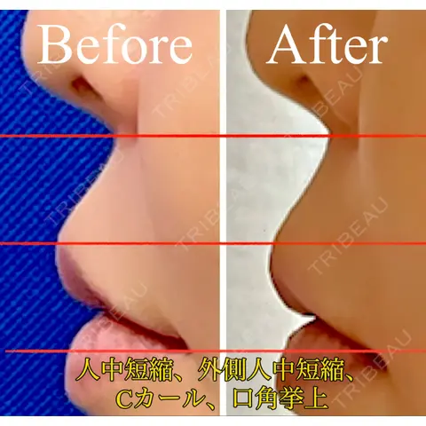 人中短縮 / 口角挙上 / ボトックス（口角） / ボトックス（人中） / その他（口元） eクリニック 金沢本院 AFTER