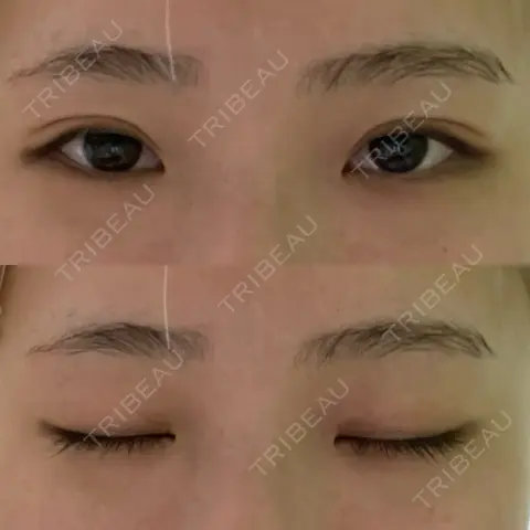 二重切開 サラ美容外科 AFTER
