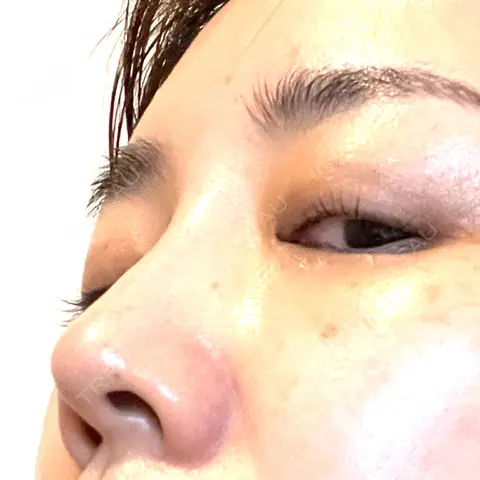 ヒアルロン酸注入（鼻） ももスキンケアクリニック AFTER