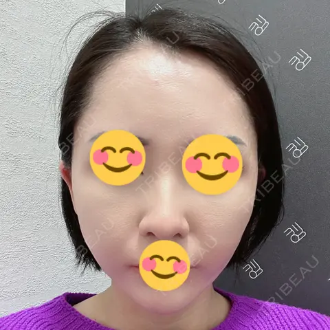 糸リフト EMMO FACE CLINIC 大宮院 AFTER