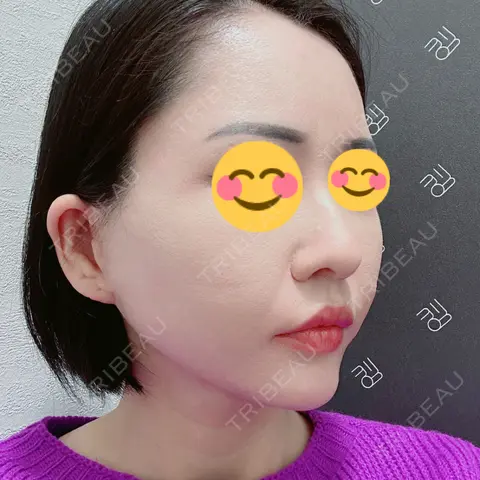 糸リフト EMMO FACE CLINIC 大宮院 AFTER