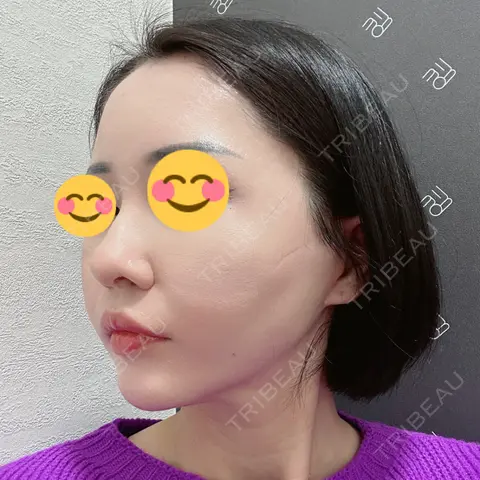 糸リフト EMMO FACE CLINIC 大宮院 AFTER