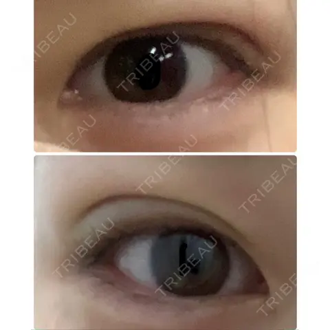 二重埋没 / 自然癒着法 ブルームクリニック（BLOOM CLINIC） DAY 0