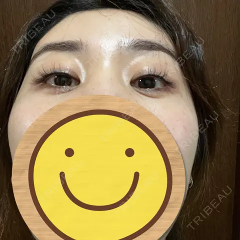 アートメイク（アイライン） 筋肉・美容クリニック AFTER